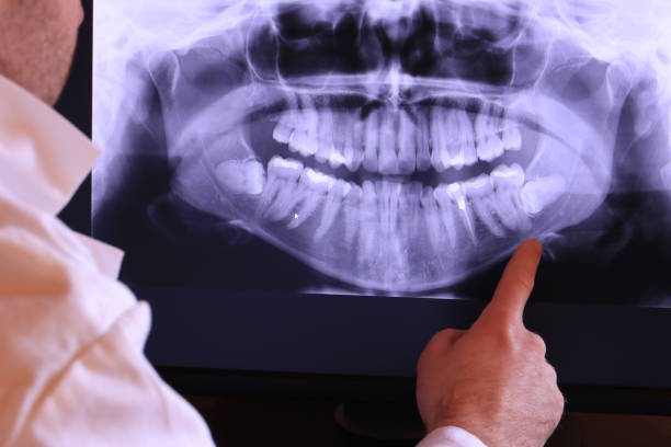 Best Emergency Wisdom Tooth Extraction in Walford, IA