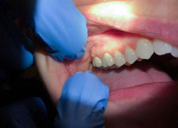 Best Knocked-Out Tooth (Avulsed Tooth) Treatment in Walford, IA